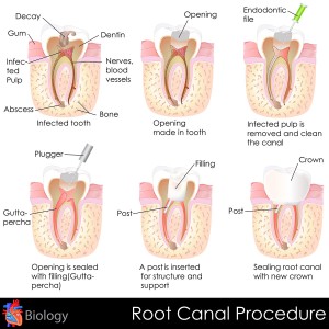 root-canal