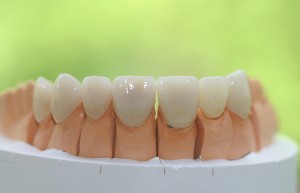 veneers